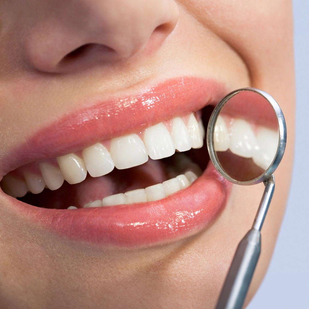 Faccette dentarie