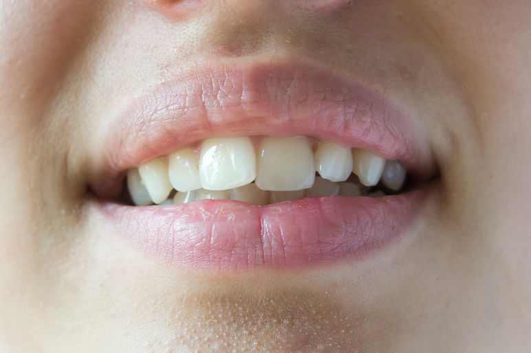 Denti accavallati: cause, conseguenze e soluzioni efficaci