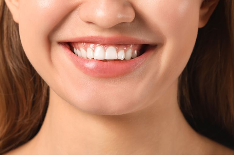 Gummy smile: cos’è e quando agire