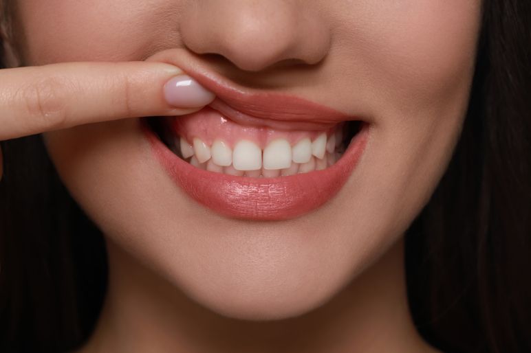 Cause recessione gengivale: tutto quello che devi sapere